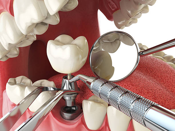 Best Emergency Root Canal Treatment in Heppner, OR